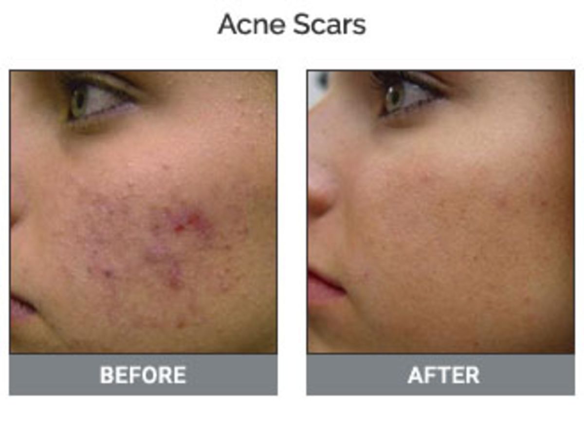 Best Acne Scars Treatment Recommended by Cosmo Care & Hair Clinic