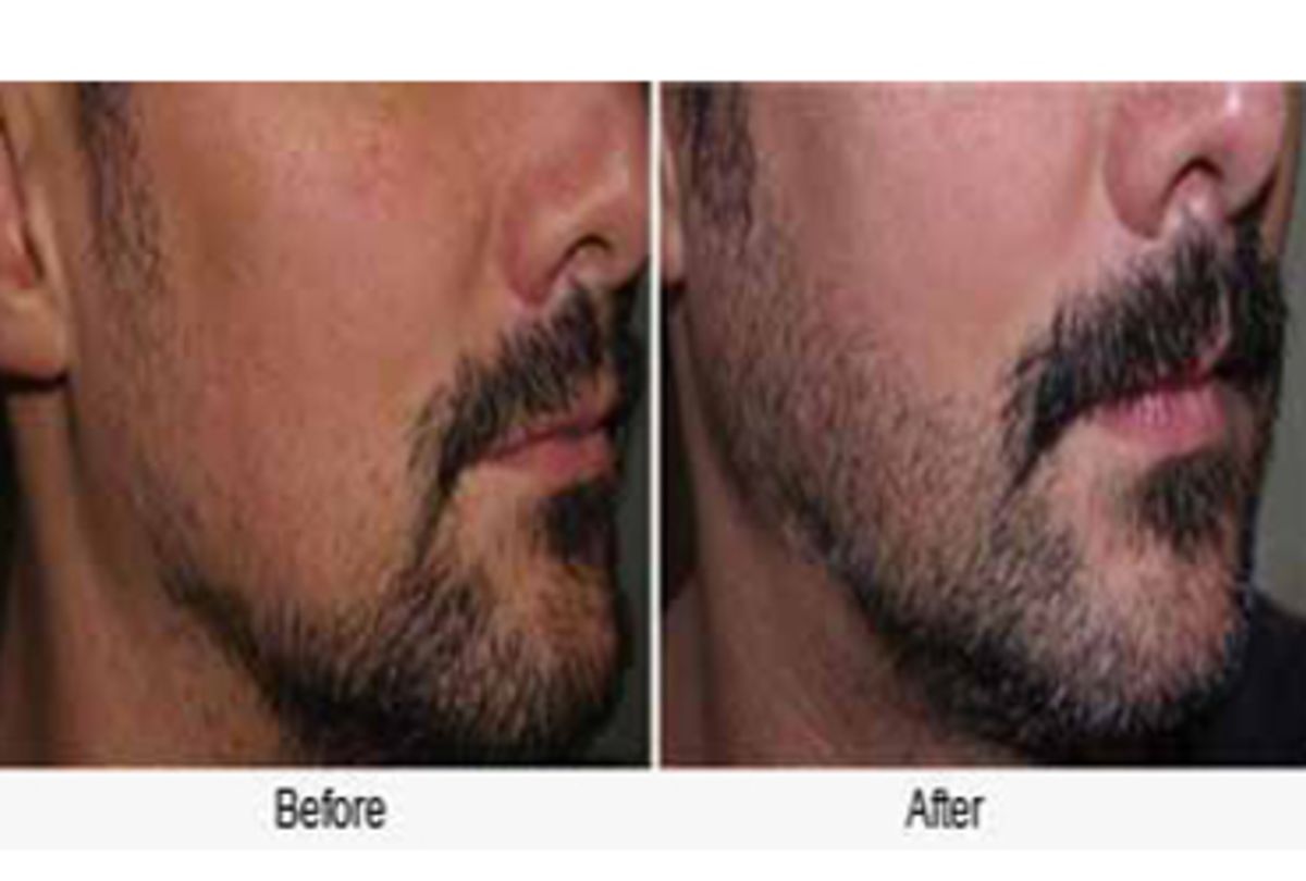 Top Beard Hair Transplant in Chandigarh