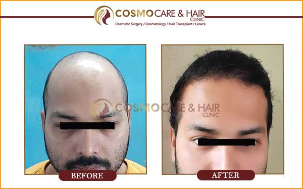 Aditya hair transplant result