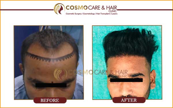 aman hair transplant result