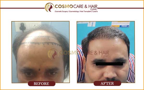 hair transplant result