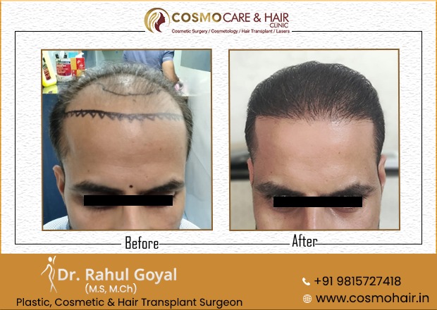 Hair Transplant Results Gallery | Before After Images