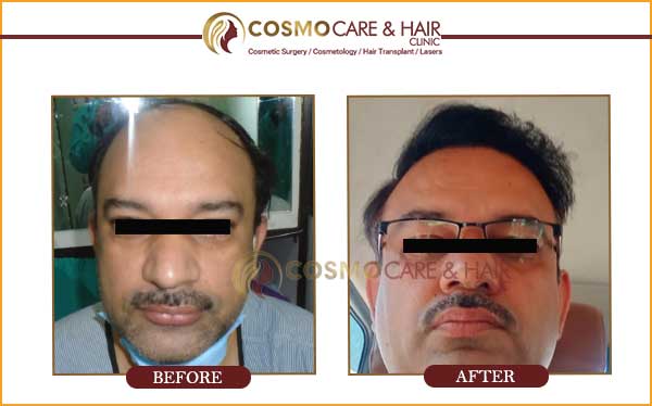 cosmo hair transplant result