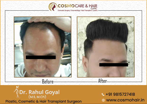 hair transplant result Chandigarh