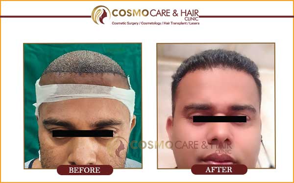 cosmo hair transplant result