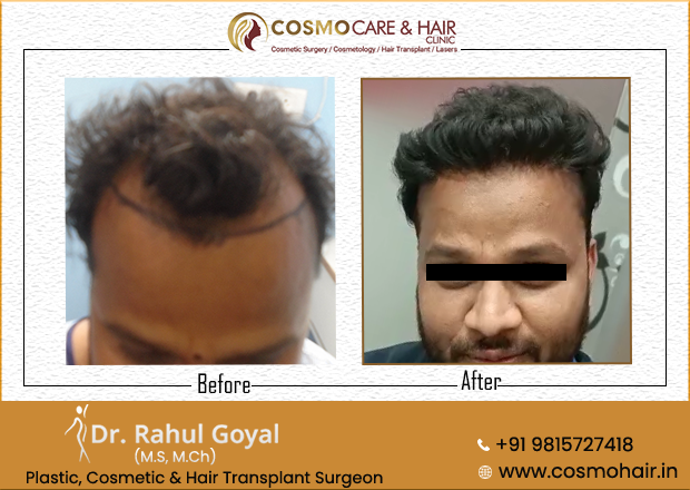hair transplant result Chandigarh