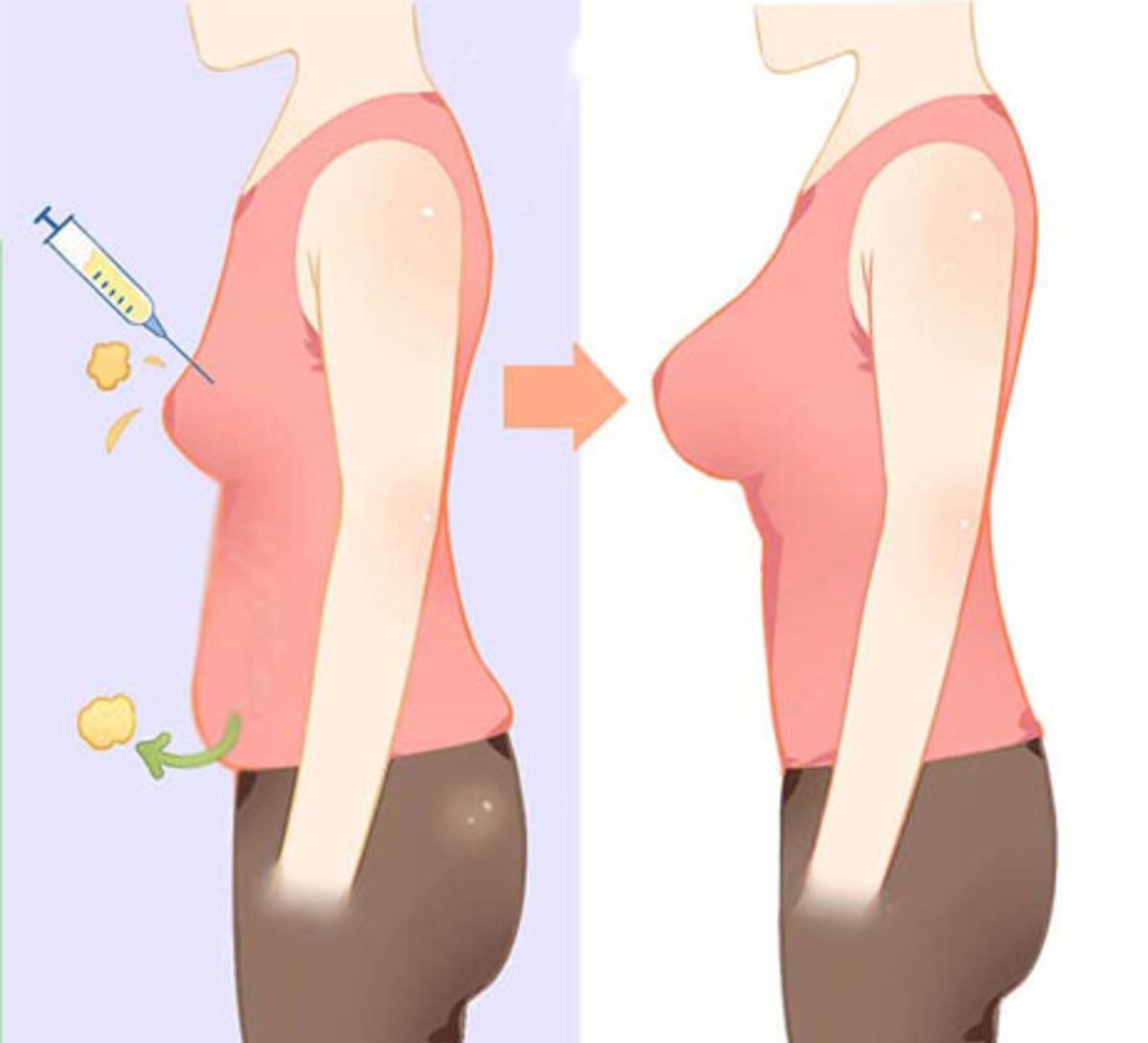 Breast Augmentation with Fat