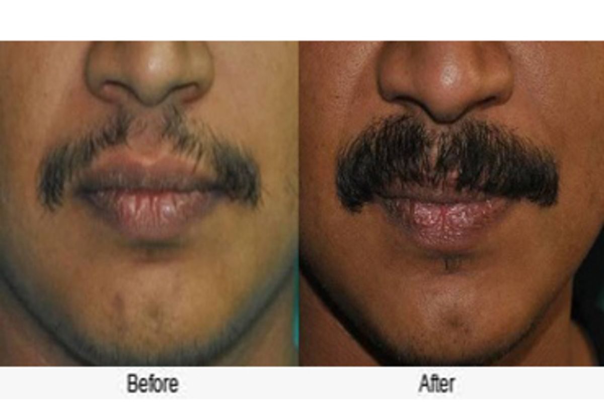 Top Moustache hair transplant in Chandigarh