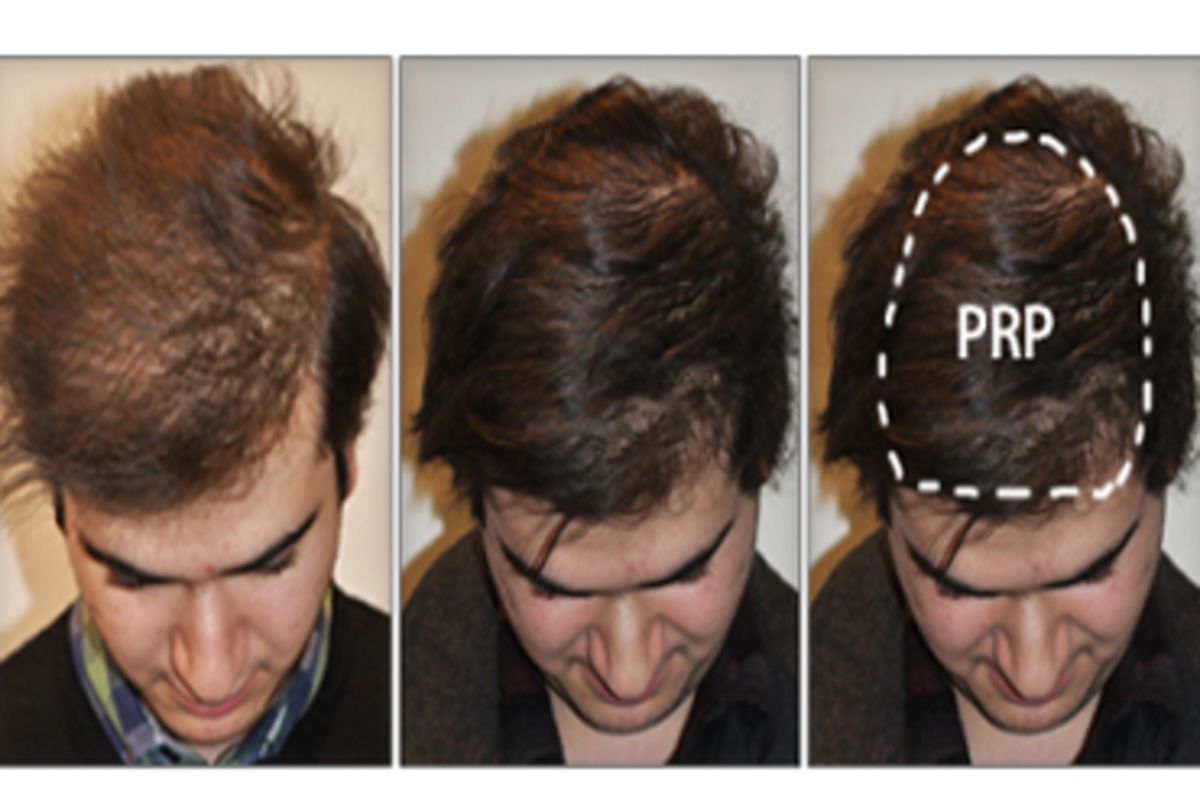 Prp Hair Growth Treatment in Chandigarh