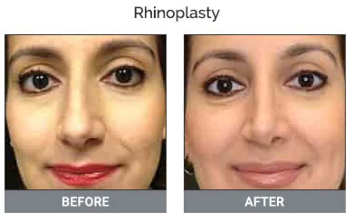 Rhinoplasty Treatment