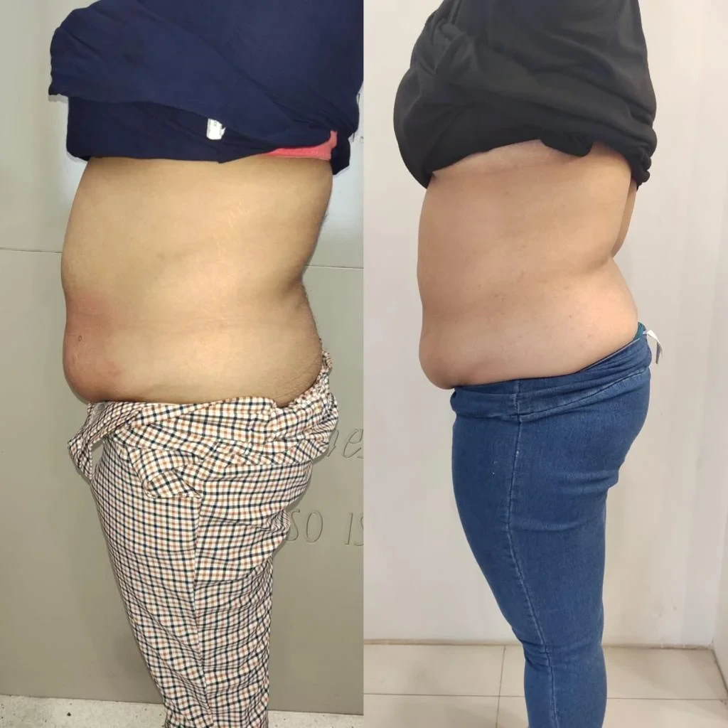 Weight Loss Pre Post Pictures Results in Cosmo Care and Hair Clinic in Chandigarh