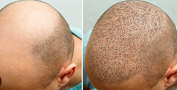 Hair Transplant Clinic In Chandigarh