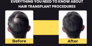 Everything You Need to Know About Hair Transplant Procedures