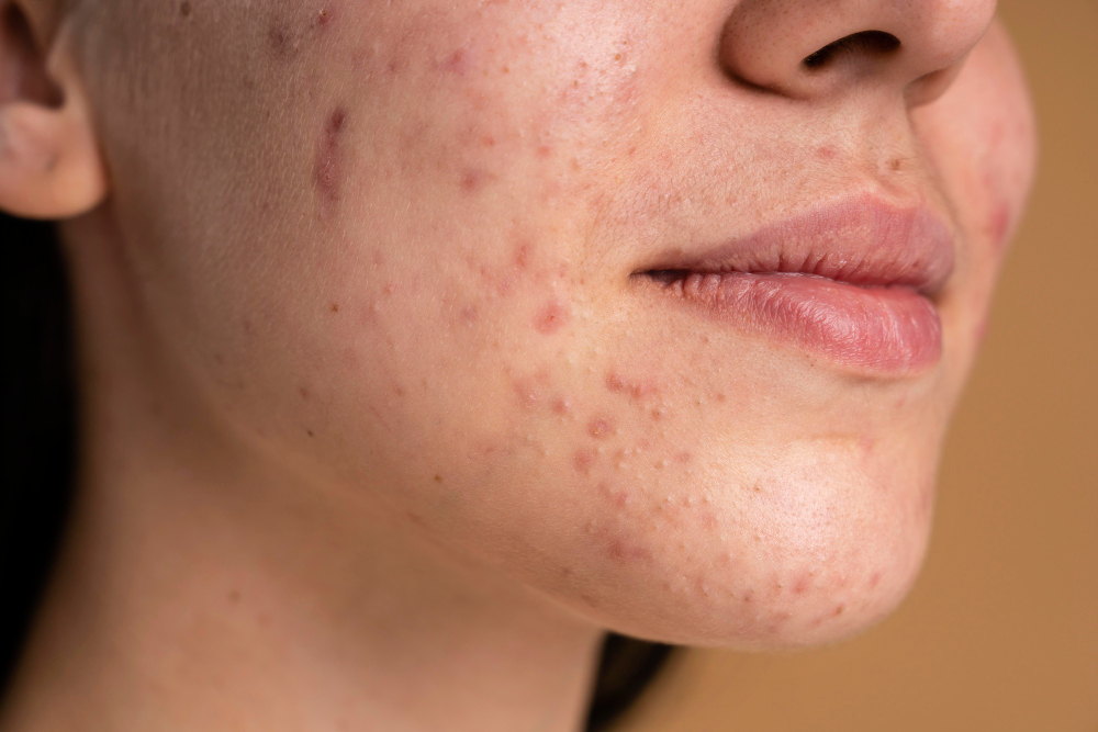 Acne Scar