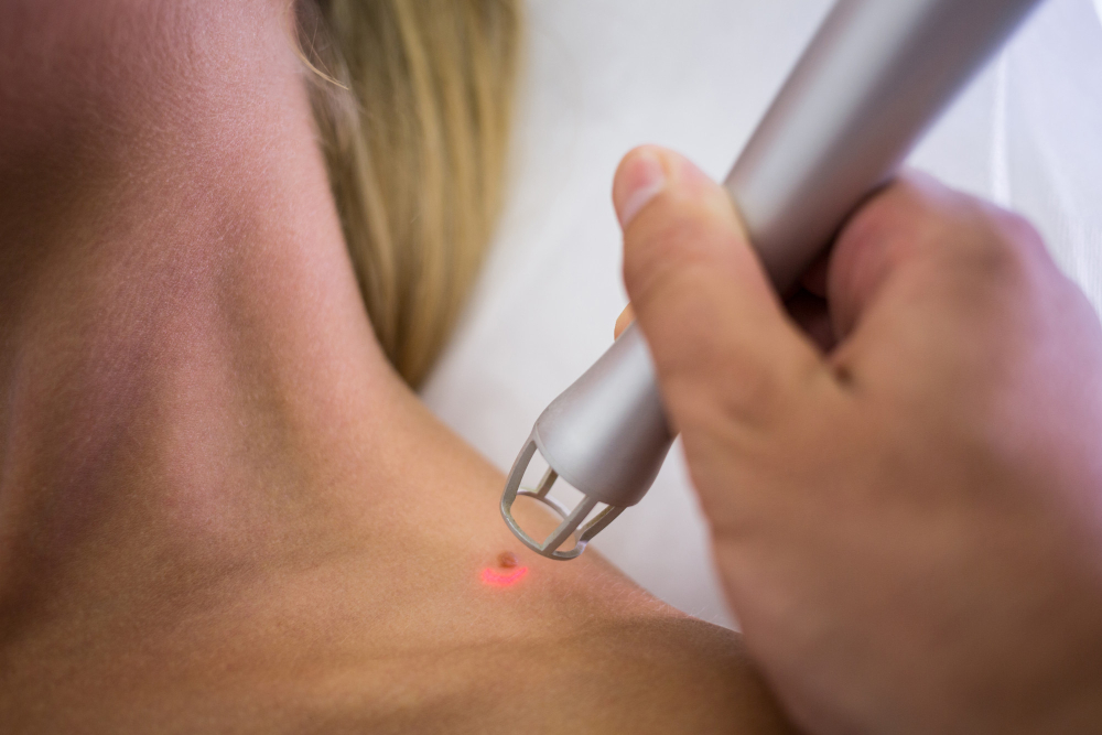 Tattoo Removal