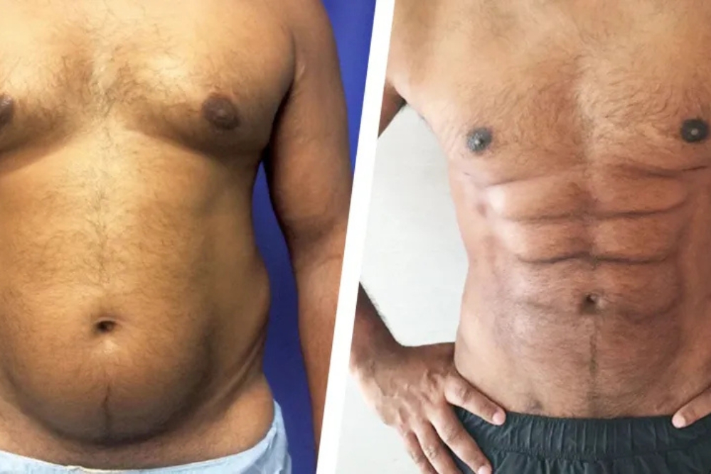 Abdominal Etching