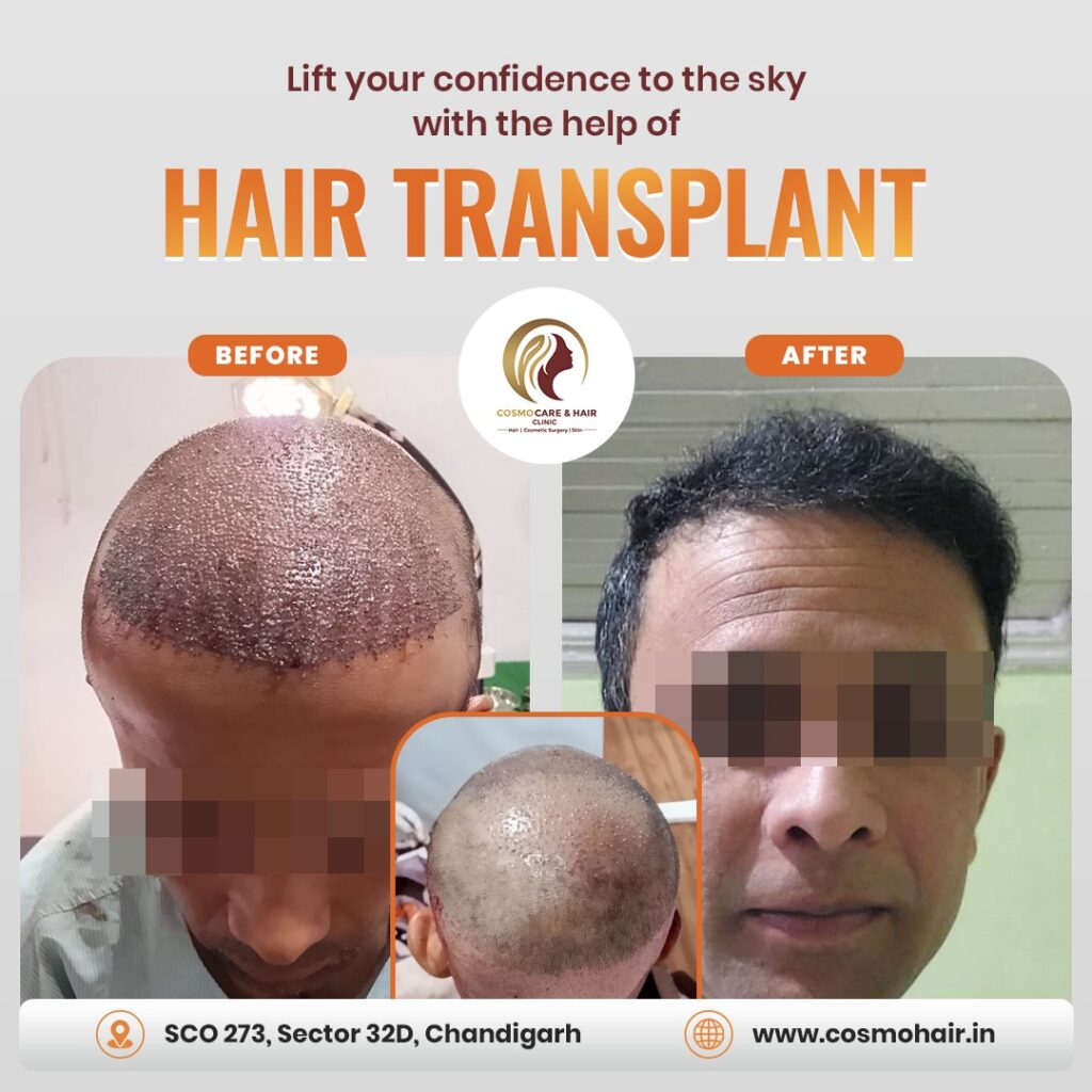 Hair Transplant in Chandigarh before and after
