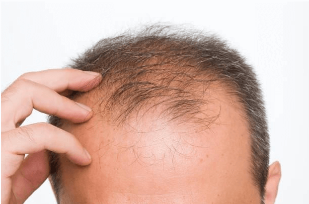 How much hair transplant cost in India