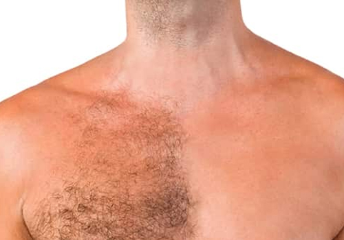 Hair Transplant By Body Hairs
