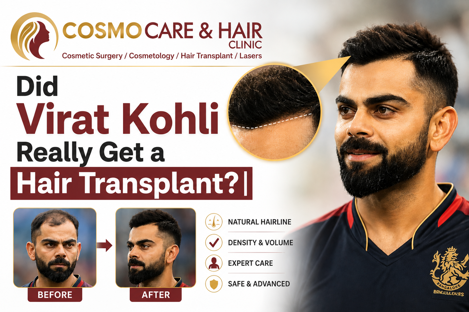 Virat Kohli Hair Transplant