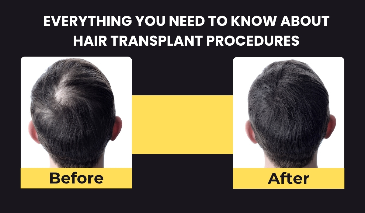 Everything You Need to Know About Hair Transplant Procedures