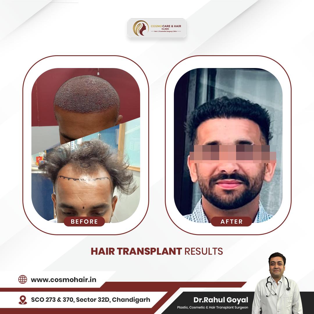 Hair Transplant Clinic in Chandigarh
