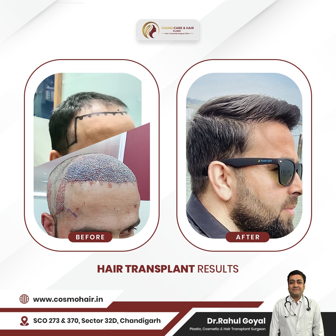 Hair Transplant Clinic in Chandigarh