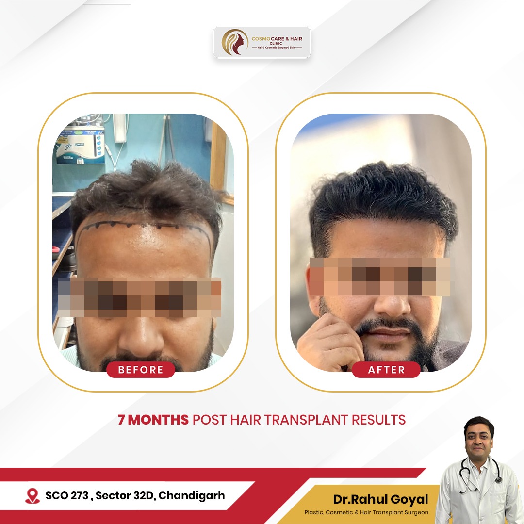 Hair Transplant Clinic in Chandigarh