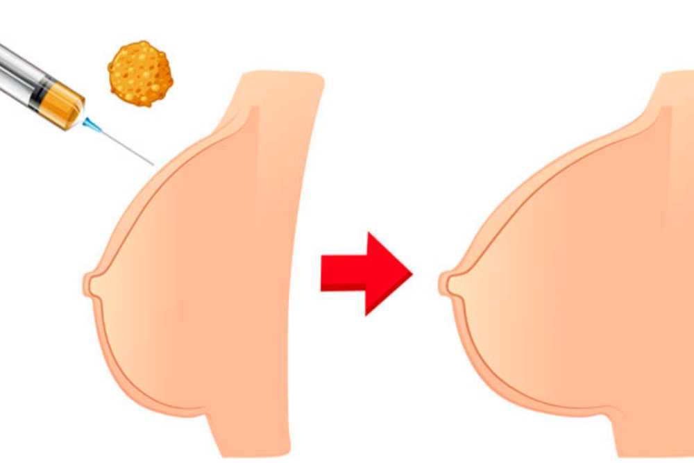 Breast Augmentation With Fat