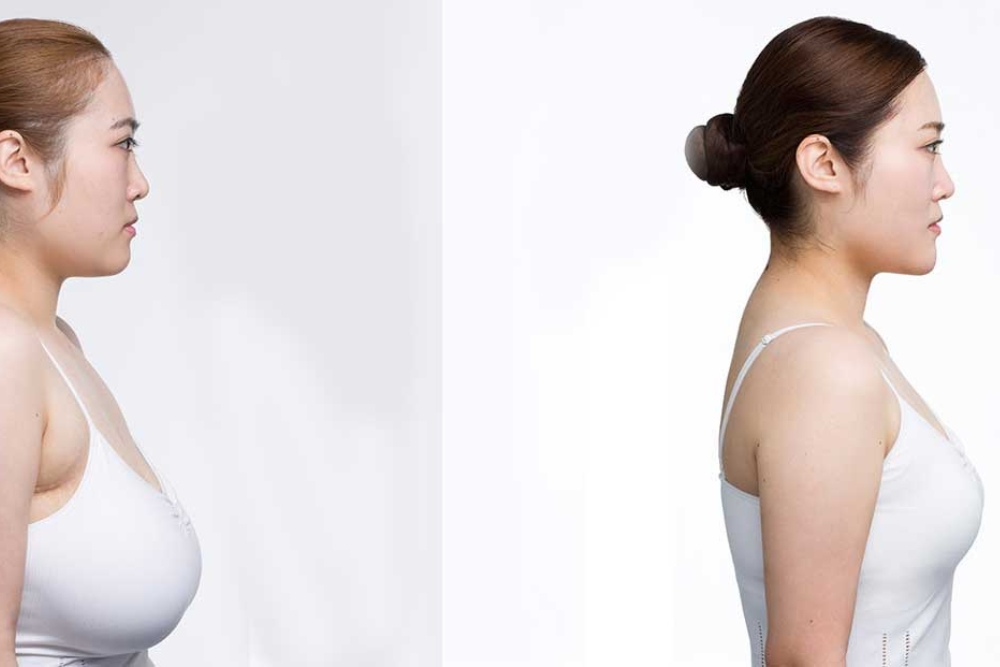 Breast Reduction Female