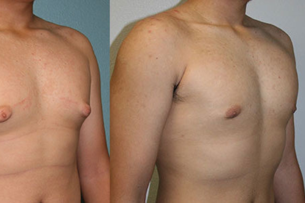 Breast Reduction Male