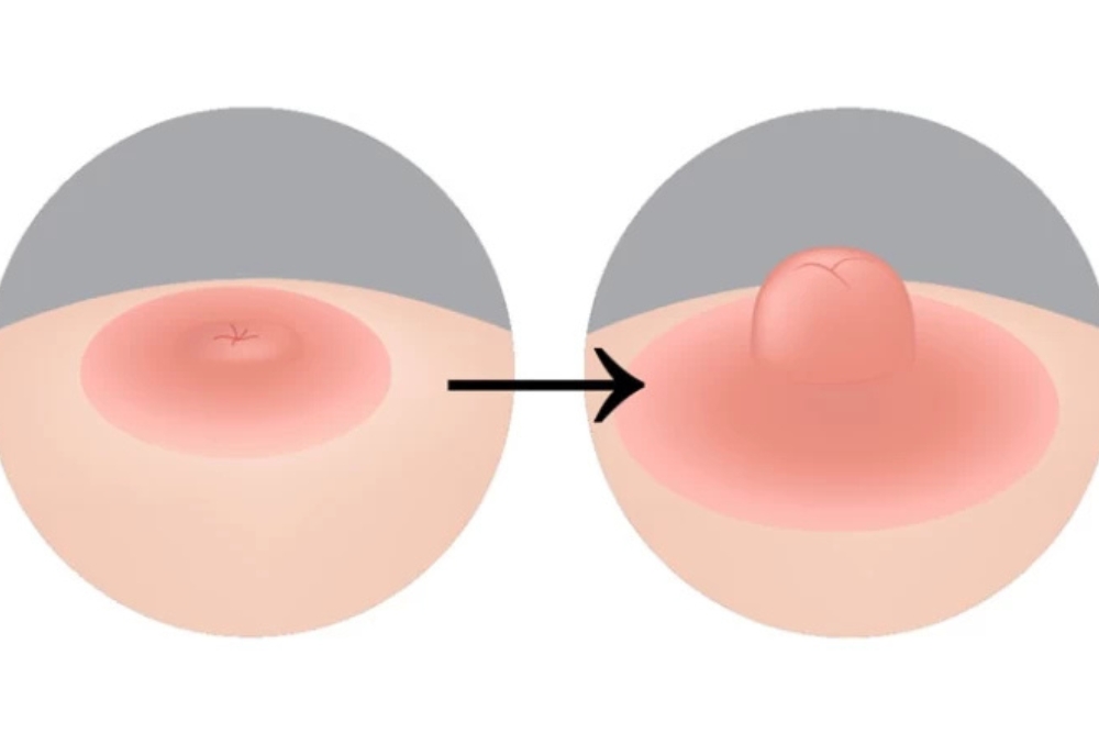 Inverted Nipples