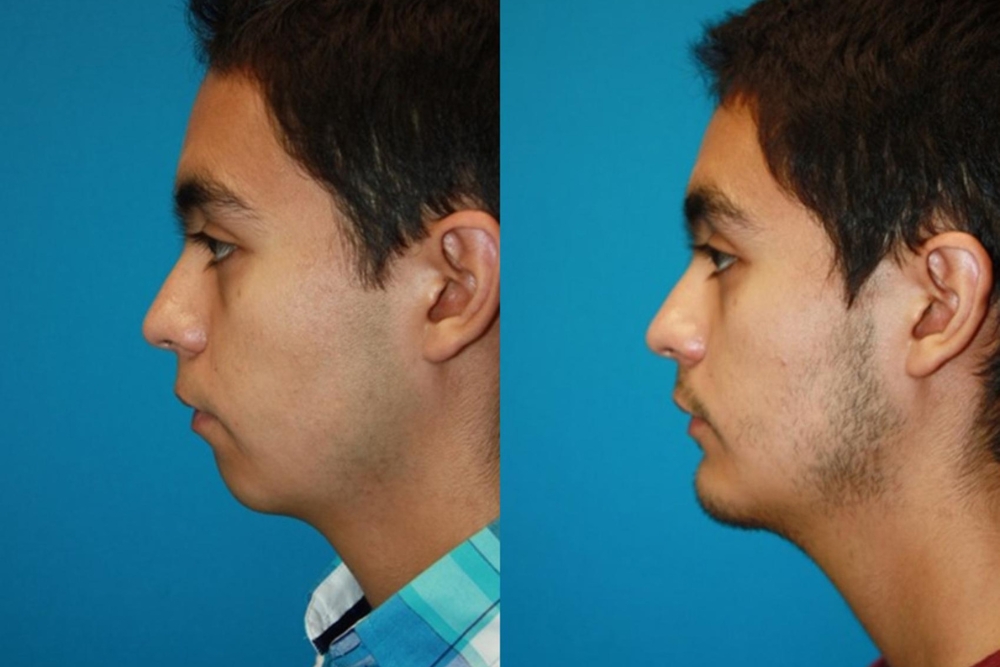 Chin Augmentation