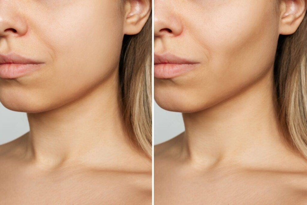 Buccal Fat Removal