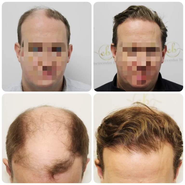 Hair Transplant in Chandigarh before and after