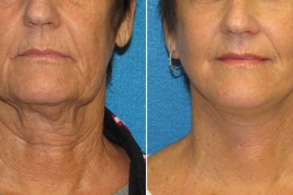 Neck Lift