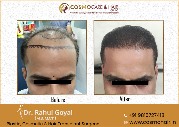Hair Transplant in Chandigarh before and after