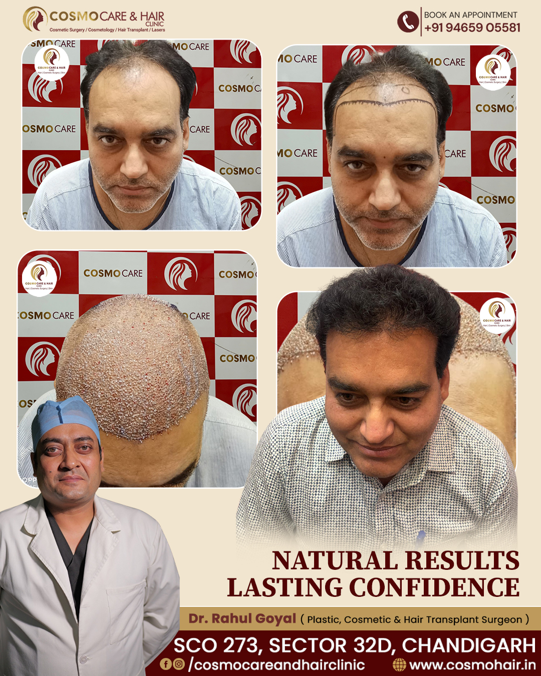 Hair Transplant Results Cosmo Care