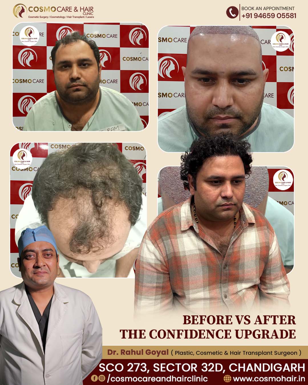 Hair Transplant Results Cosmo Care