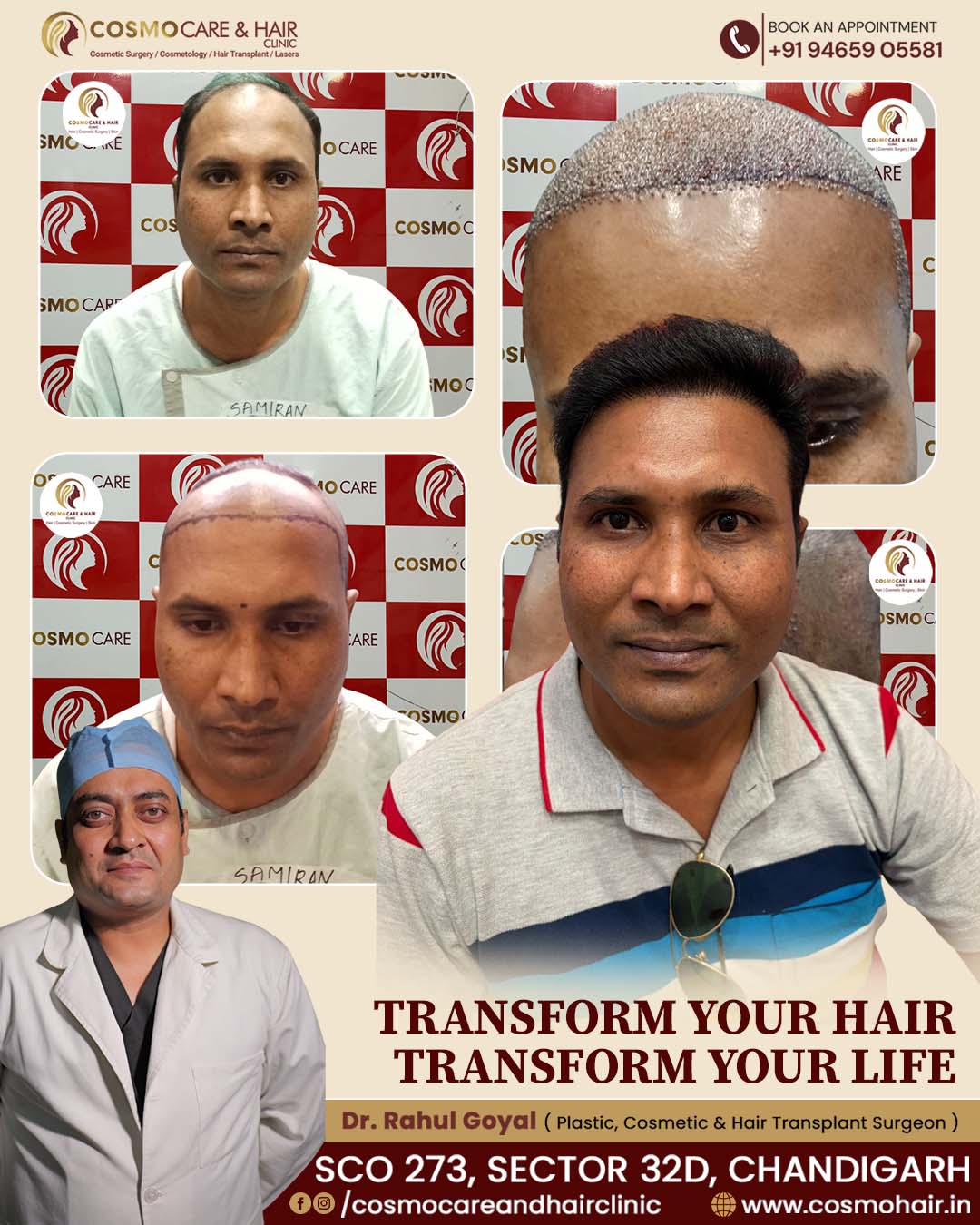 Hair Transplant Results Cosmo Care