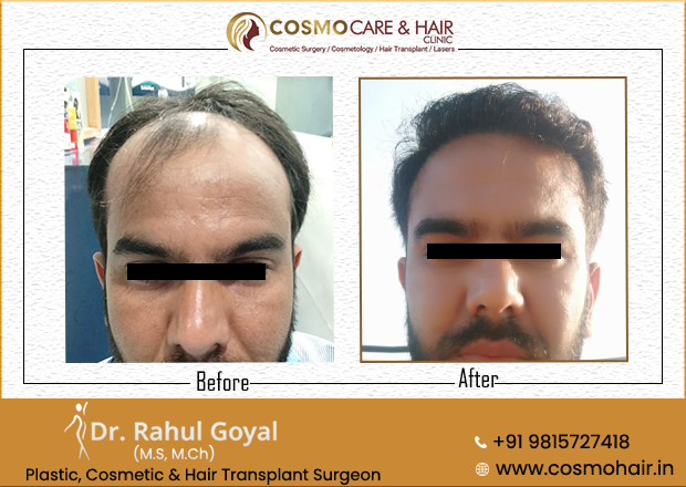 Hair Transplant in Chandigarh before and after