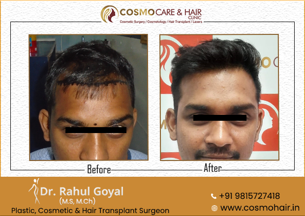 Hair Transplant in Chandigarh before and after