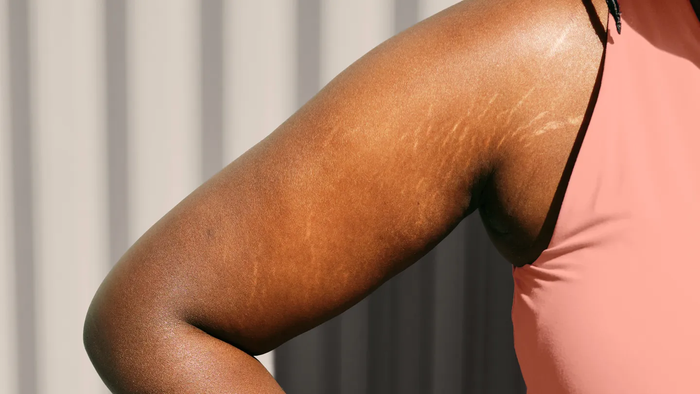 stretch marks