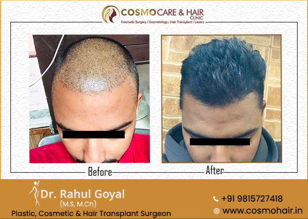 Hair Transplant in Chandigarh before and after
