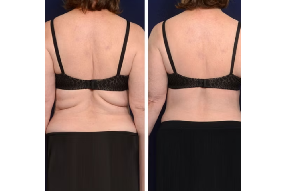 Upper Body Lift