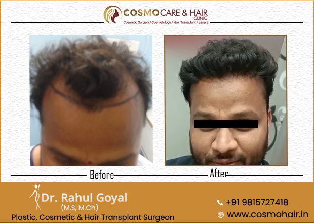 Hair Transplant in Chandigarh before and after