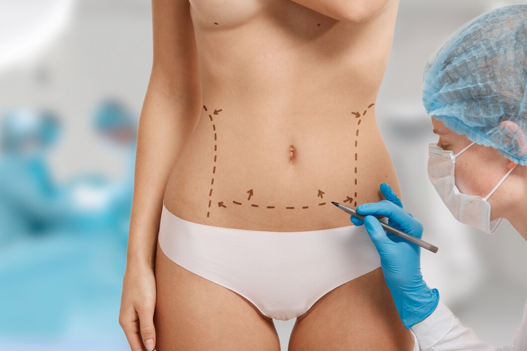 Pannicculectomy