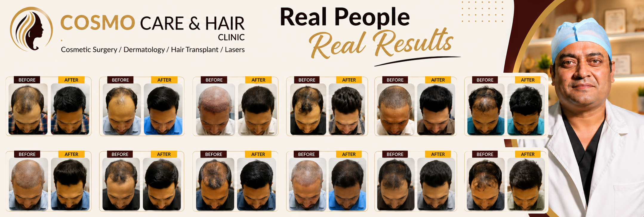 Hair Transplant Results in Chandigarh