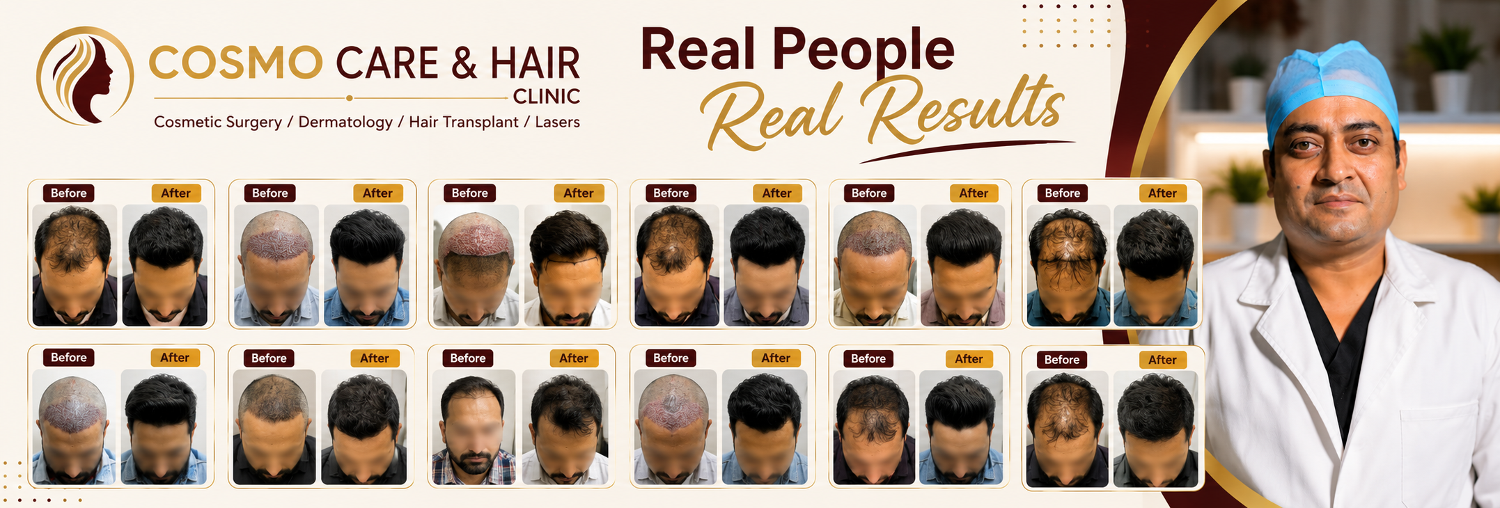 Hair Transplant Results in Chandigarh