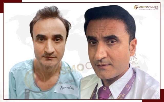 Hair Transplant In Chandigarh